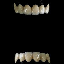 Doğal Görünümlü CAD-CAM Zirkon Porselen Kron